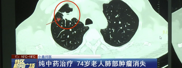 扩散救人，纯中药治疗肿瘤消失！！